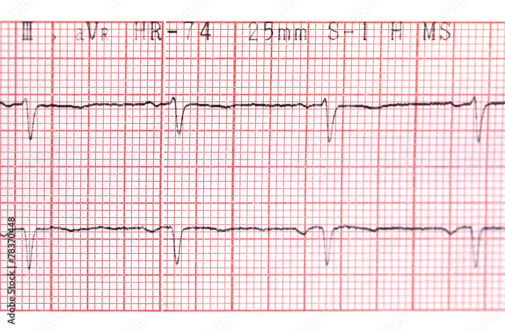 Electrocardiograph Electrocardiograph