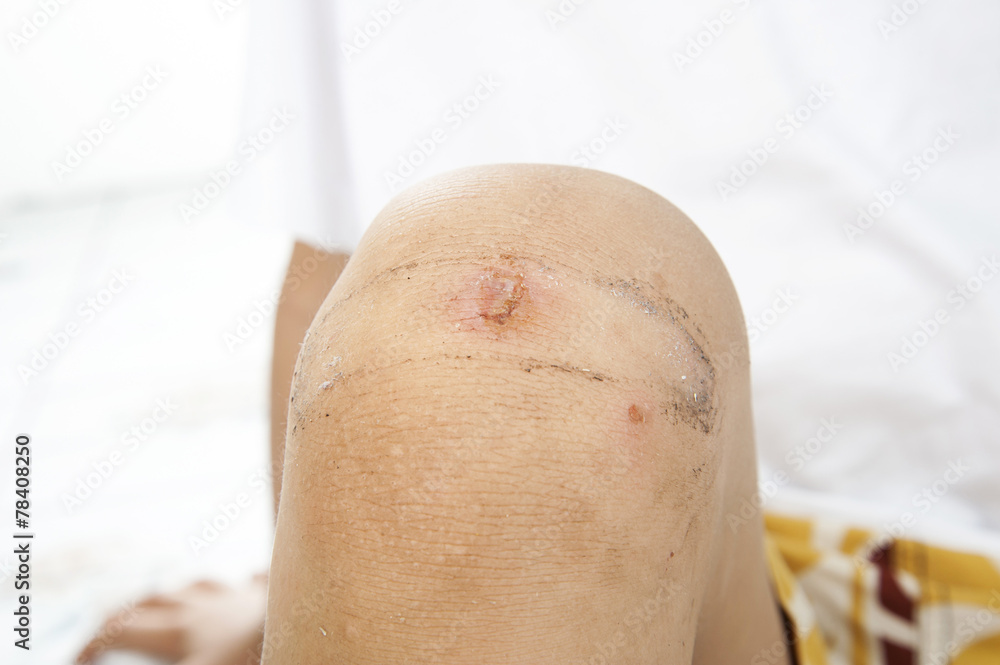 Wound on boy knee Wound on boy knee