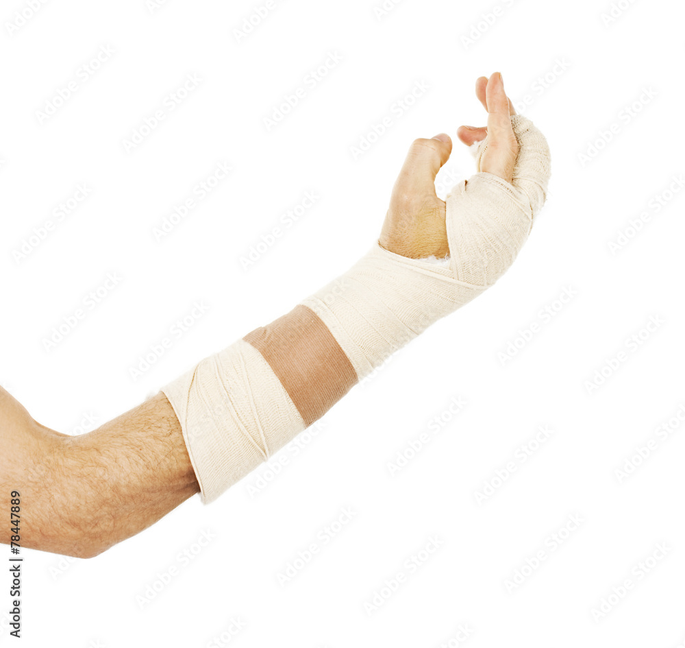 Broken arm bone in cast. Isolated on white background Broken arm bone in cast. Isolated on white background