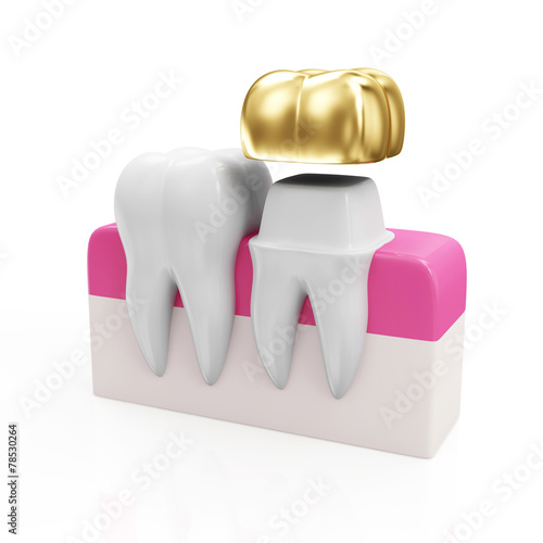 Health Tooth and Teeth with Golden Dental Crown