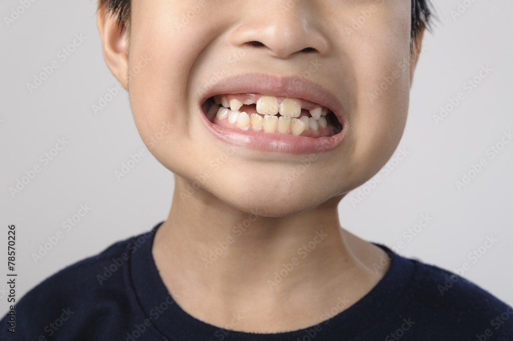 Boy checking tooth by mirror Boy checking tooth by mirror