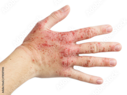 Eczema on a female hand photo