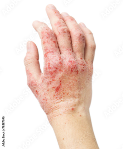 Eczema on a female hand photo