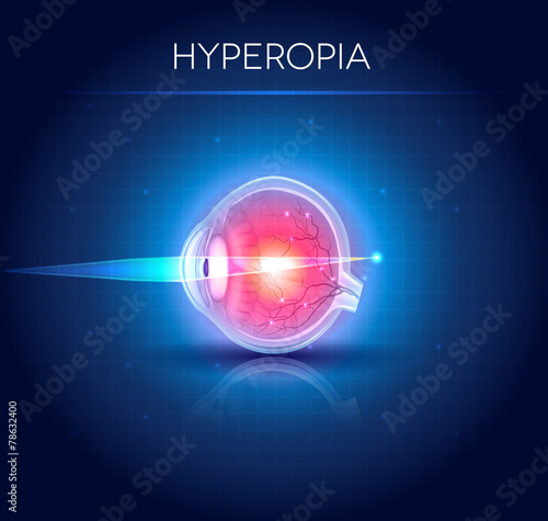 Hyperopia eyesight disorder