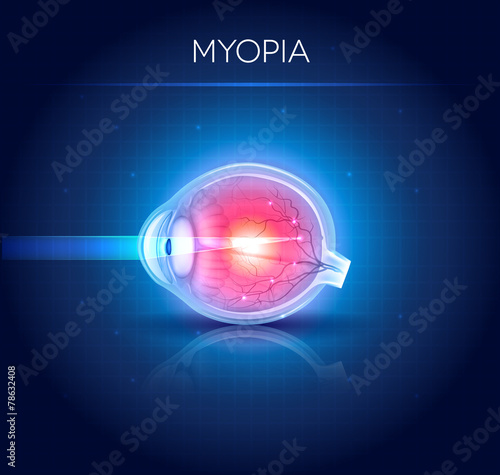 Myopia eyesight disorder