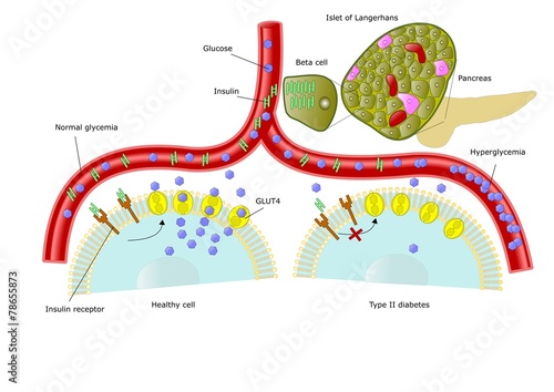 diabete di tipo 2, iperglicemia e scarsa insulina
