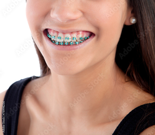 Smiling teenager girl with brackets