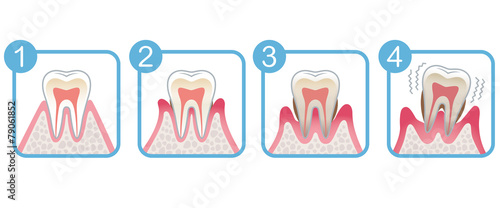 歯の断面図　歯周病 #79061852
