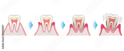 歯の断面図　歯周病 photo