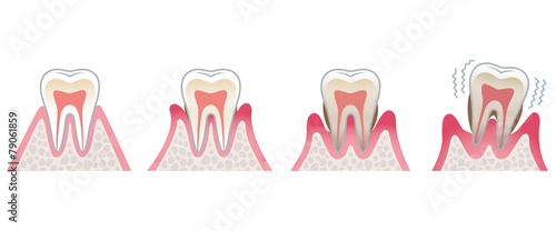歯の断面図　歯周病 #79061859