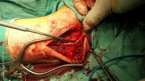 ulnar nerve surgery photo