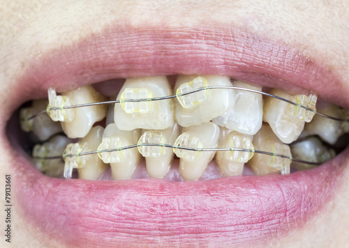 Close-up mouth of crooked teeth with braces.