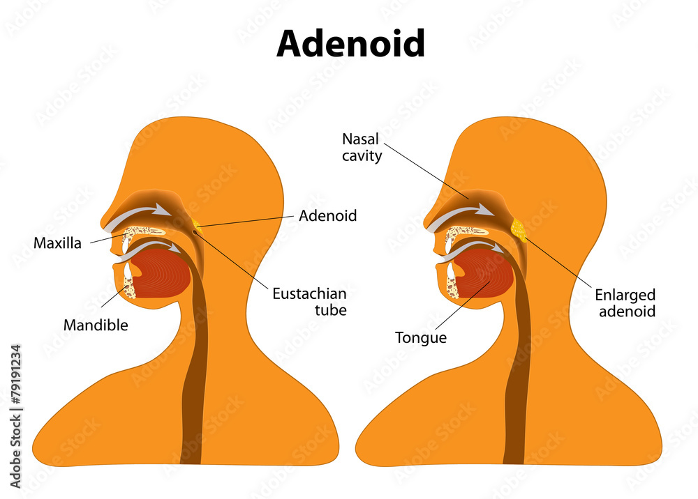 adenoid-normal-and-enlarged-adenoid-stock-vector-adobe-stock