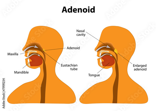 Adenoid. Normal and Enlarged adenoid photo