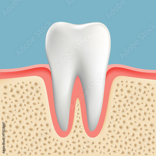 Vector image of a human tooth with caries