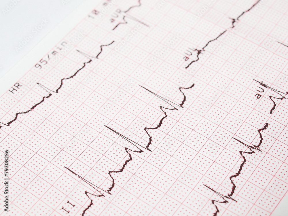 Electrocardiogram, ECG printout, EKG background