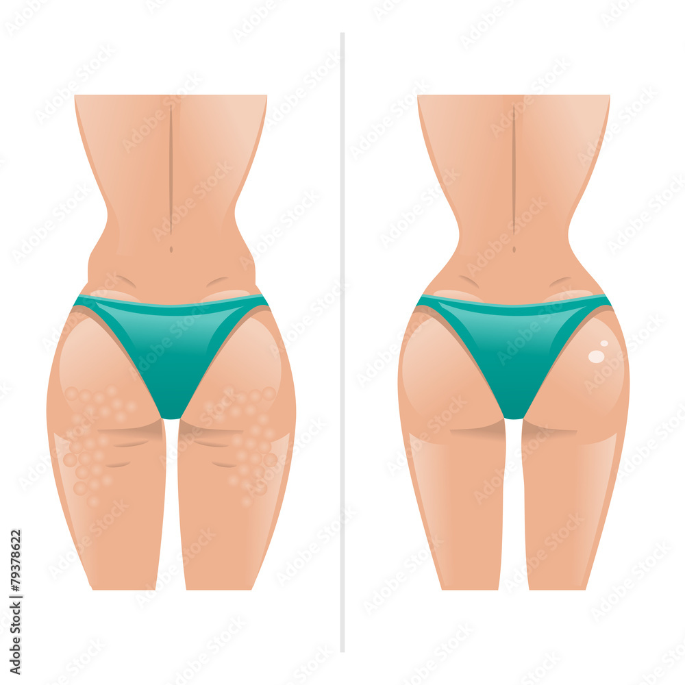 Vector illustration of cellulite and healthy skin Vector illustration of cellulite and healthy skin