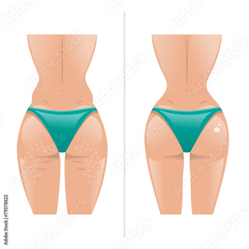 Vector illustration of cellulite and healthy skin