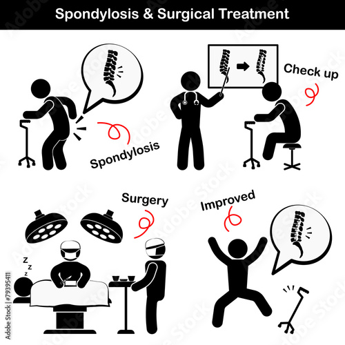 Spondylosis,Spondylolisthesis and Surgical Treatment