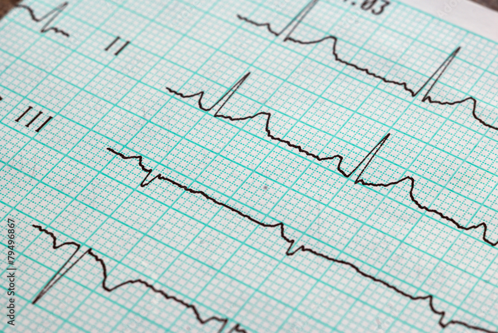 graph of cardiogram