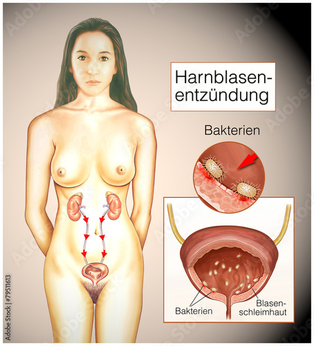Blasenentzündung.Bakterien