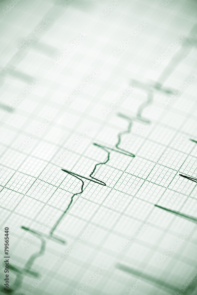 Electrocardiogram Electrocardiogram