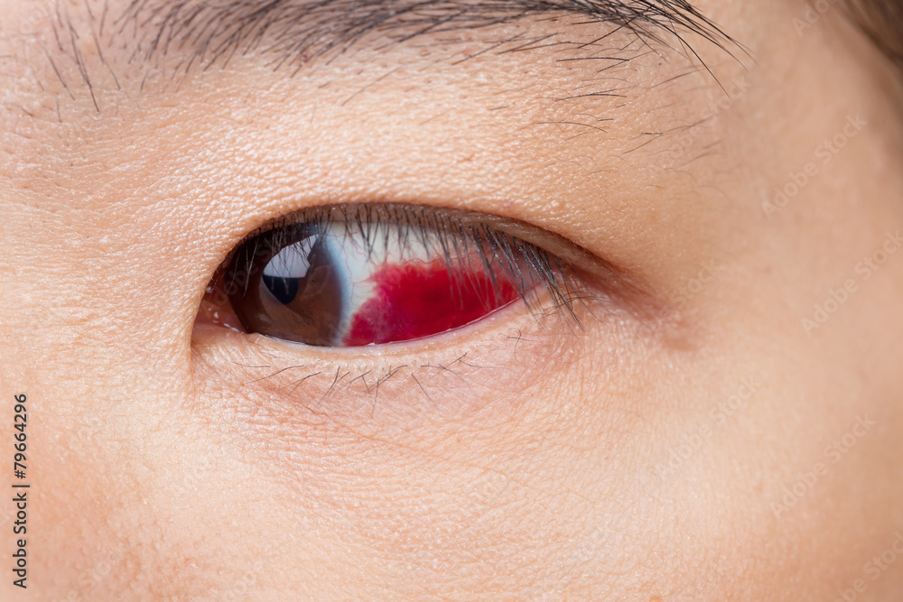 Fototapeta premium Eye injury or infected for healthy concept, macro closeup