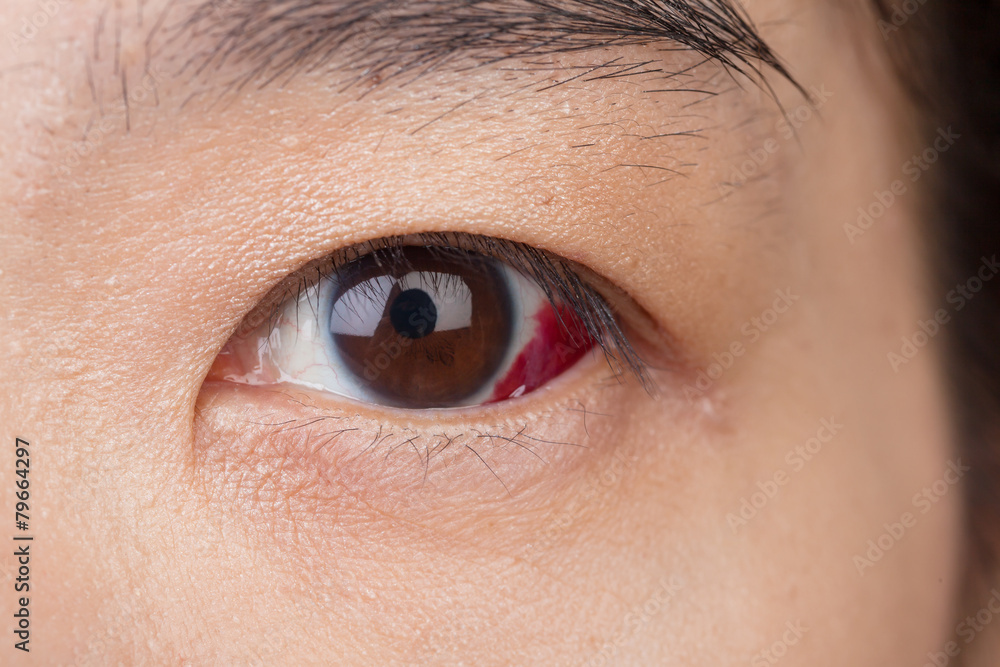 Obraz premium Eye injury or infected for healthy concept, macro closeup