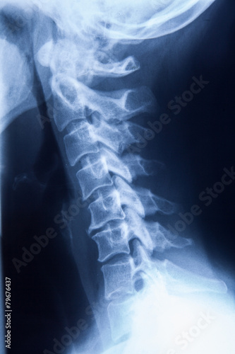 X ray MRI - Image of Spinal Column Neck pain and Skull Head Stre