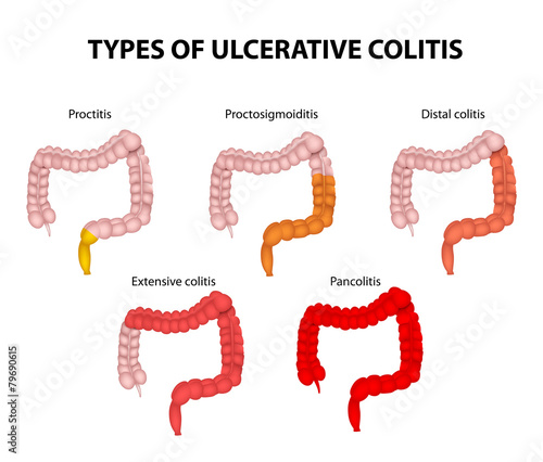 Types of Ulcerative Colitis photo
