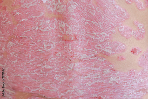 Psoriasis dry skin texture detail background of an adult male