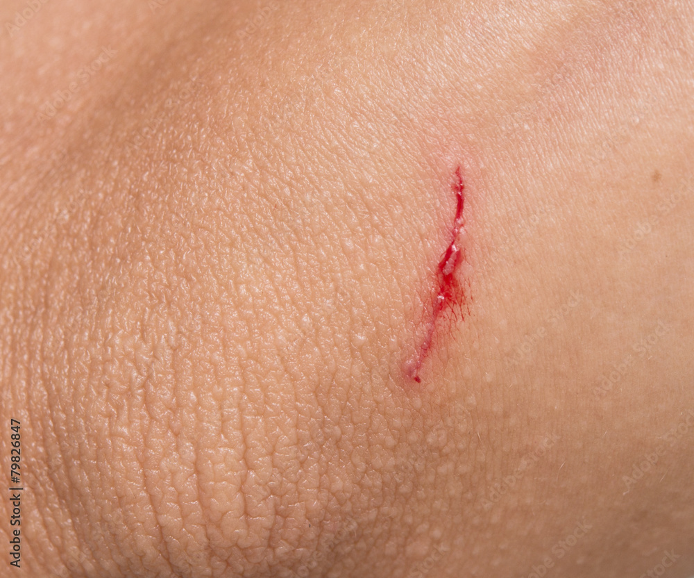 Fototapeta premium wound