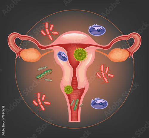 Ill female reproductive system. Vector illustration