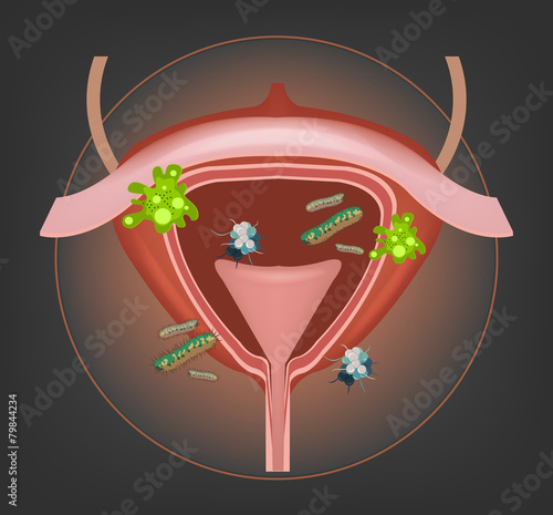 Human bladder with bacteria and germs.