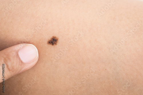 Birthmark on skin