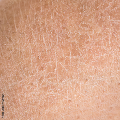 dry skin (ichthyosis) detail