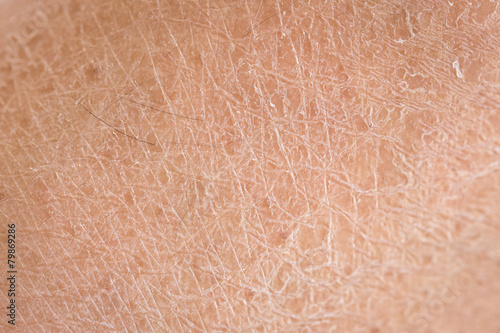 Obraz na plátně dry skin (ichthyosis) detail