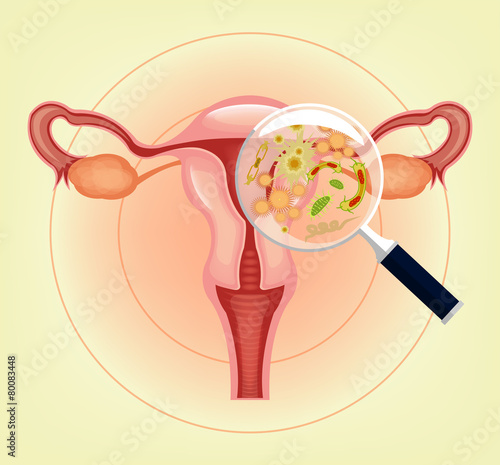 Ill female reproductive system with bacteria