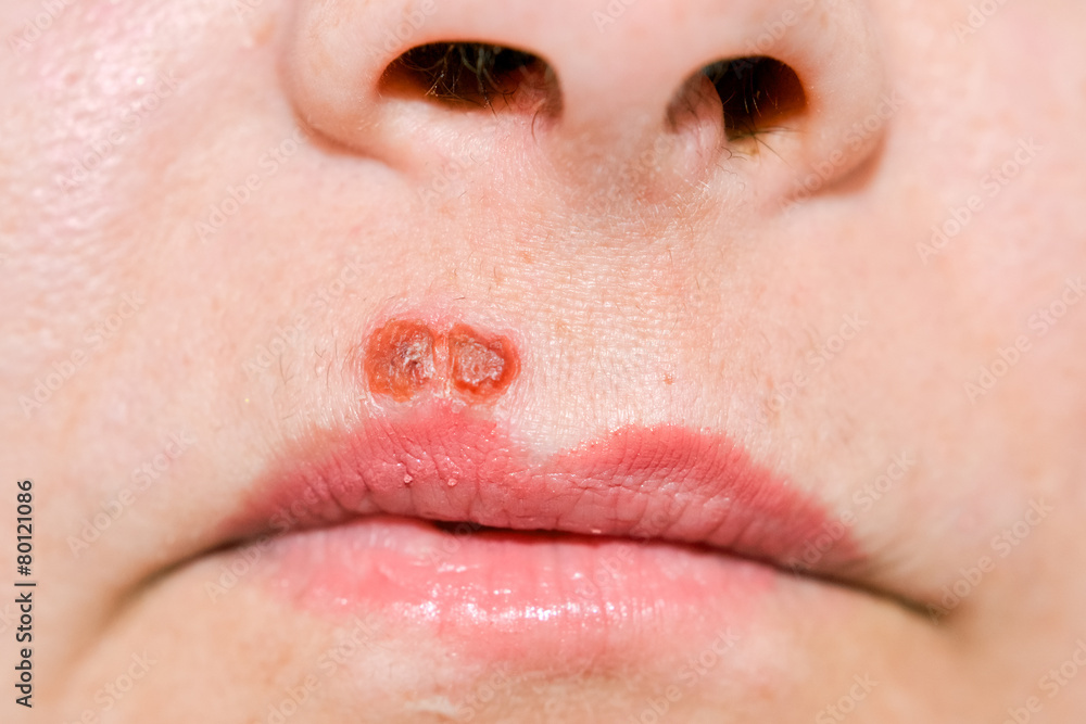 Obraz premium Herpes virus