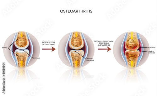 Osteoarthritis detailed illustration. From healthy joint to dama