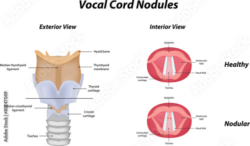 Vocal Cord Nodules