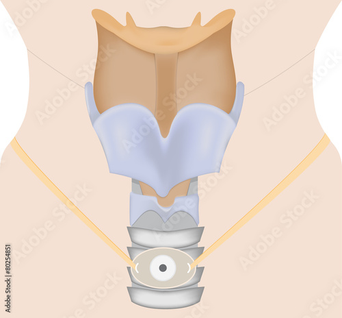 Tracheostomy