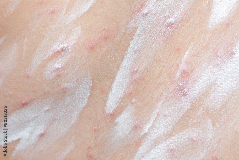 Fototapeta premium Detail baby with chicken pox rash