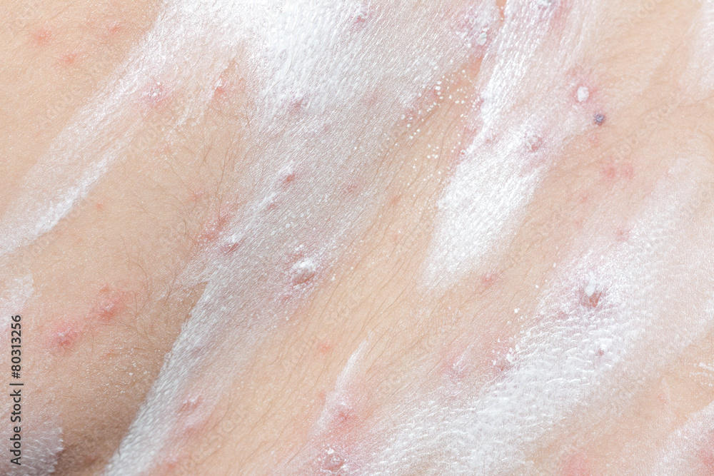 Fototapeta premium Detail baby with chicken pox rash