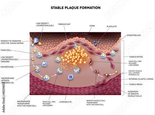 Stable plaque formation in the human artery. Atherosclerosis