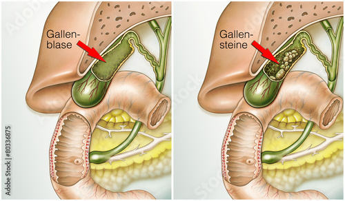 Gallenblase mit und ohne Gallensteinen photo