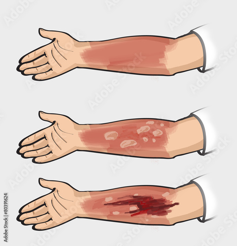 Classification of burns. Thermal injuries.