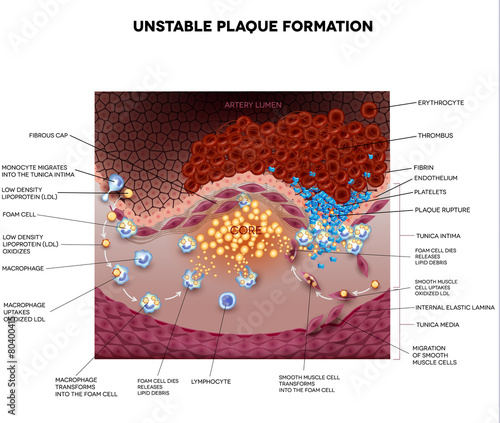 Thrombus, blood clot, unstable plaque  formation in the artery