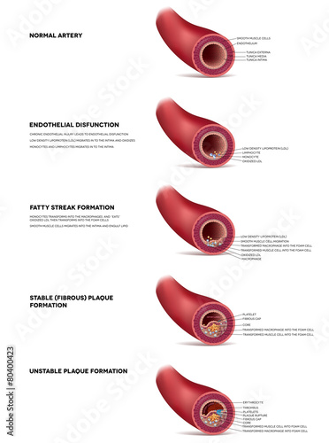 Atherosclerosis detailed illustration, progression till Thrombus