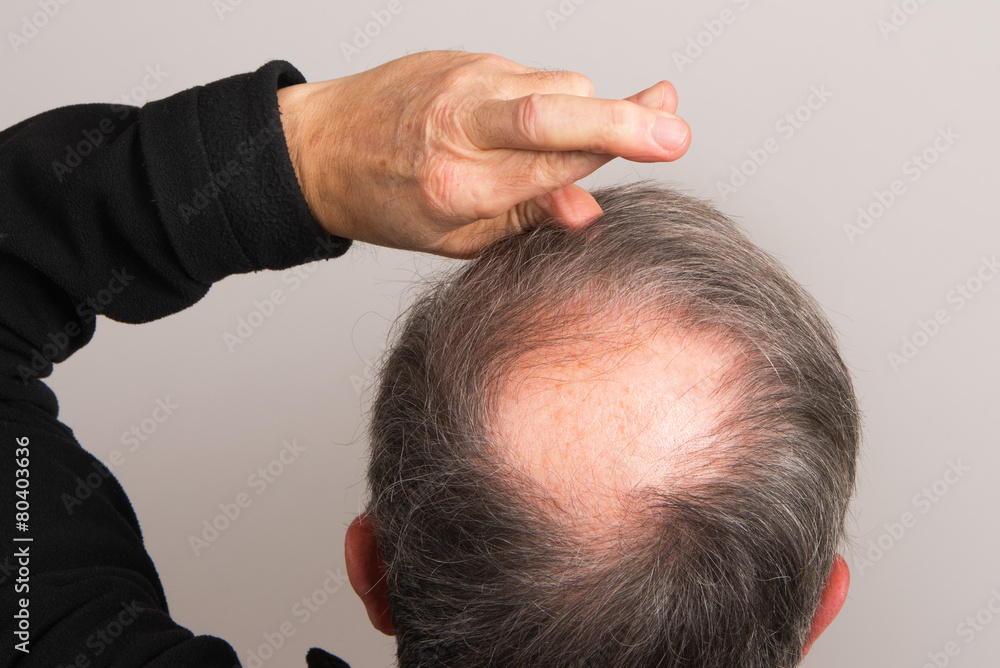 Obraz premium Bald Patch